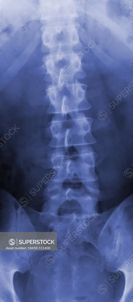 radiograph of a spinal column