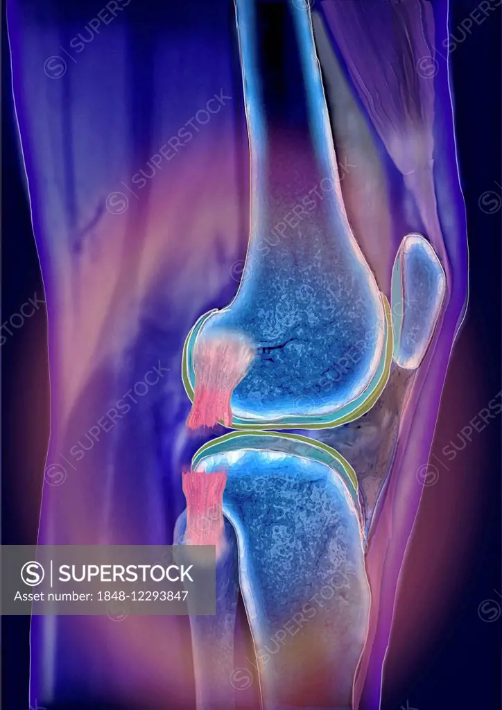 Knee joint, Articulatio genus, lateral collateral ligament injury, computed tomography