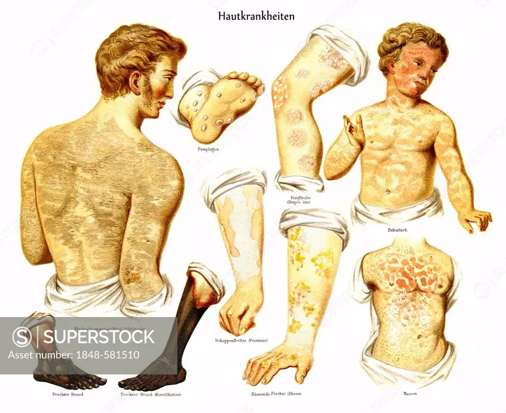 Historic illustration of skin diseases, dermatoses, measles, scarlet fever, psoriasis, herpes, 19th century, Meyers Konversations-Lexikon encyclopedia...
