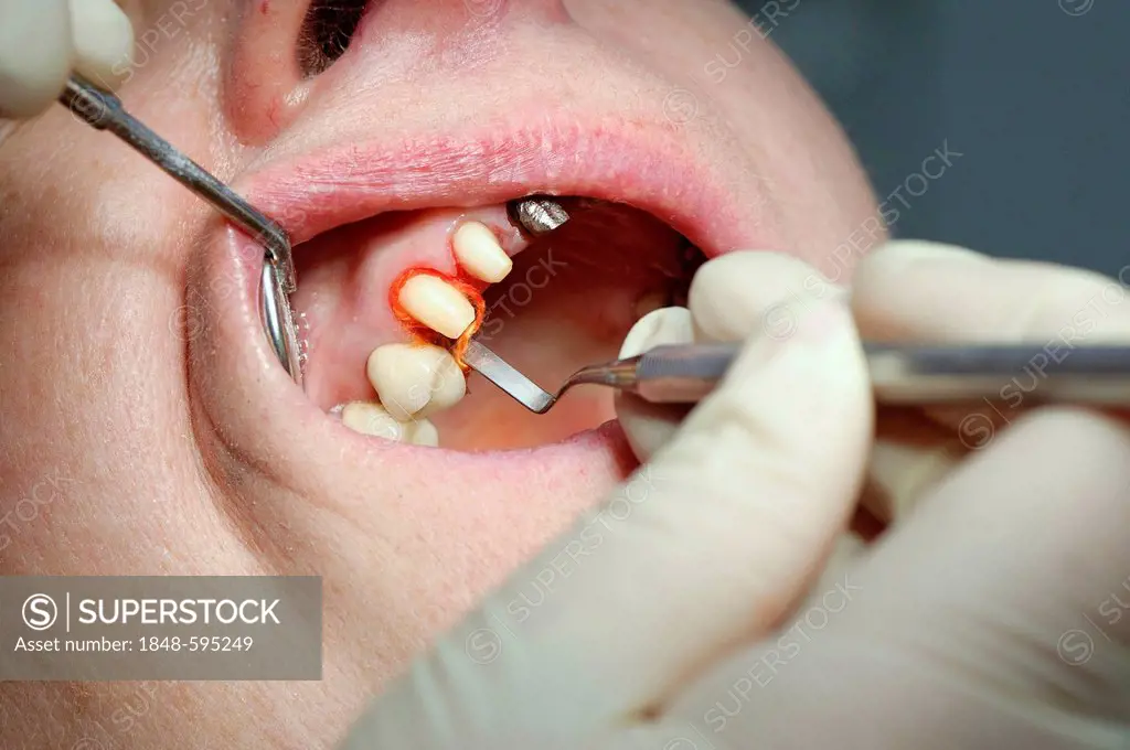 Retraction cord wrapped around the stump of a tooth during dental treatment