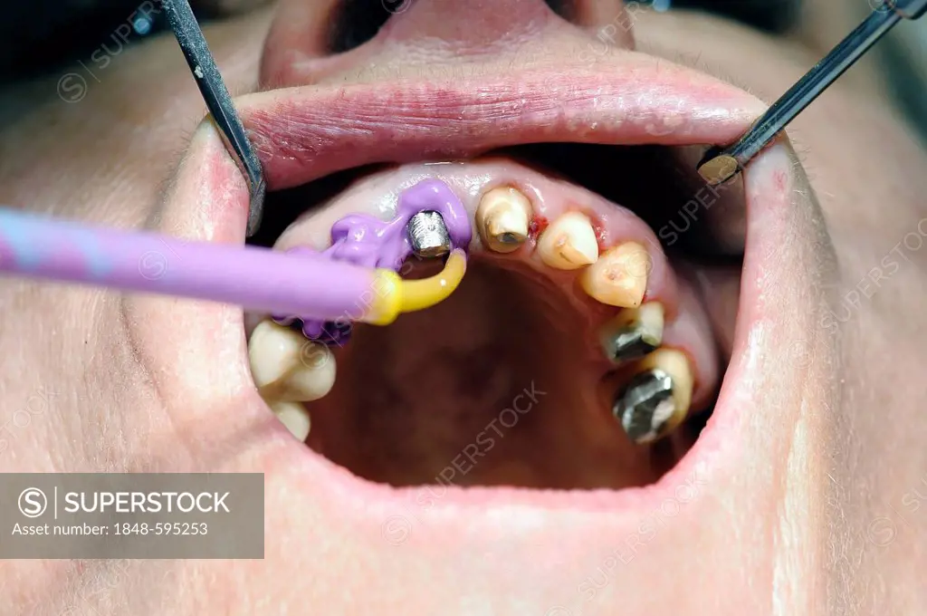 Mass being applied for the corrective impression during dental treatment
