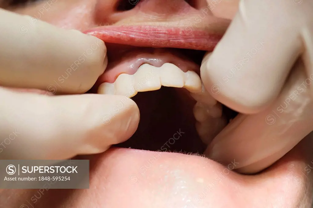 Adjusting the provisional crowns during dental treatment