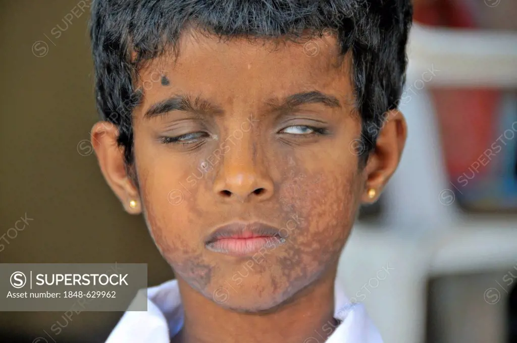 Girl blinded by an infection, school for the blind, Tangalle, Sri Lanka, Ceylon, South Asia, Asia