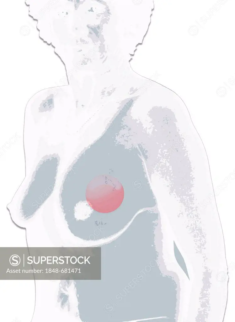 Illustration, woman with breast cancer