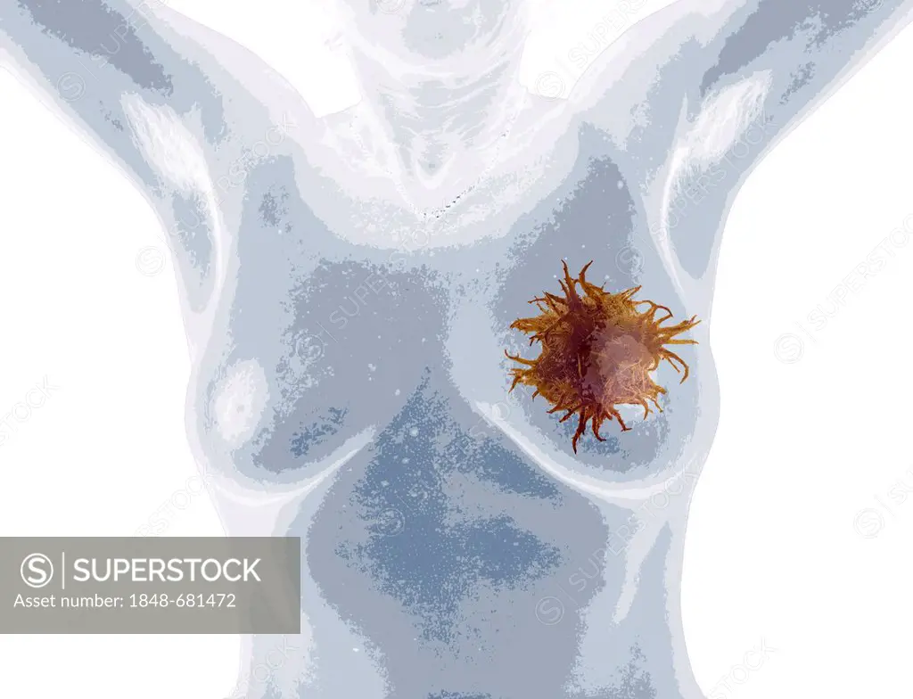 Illustration, woman with breast cancer