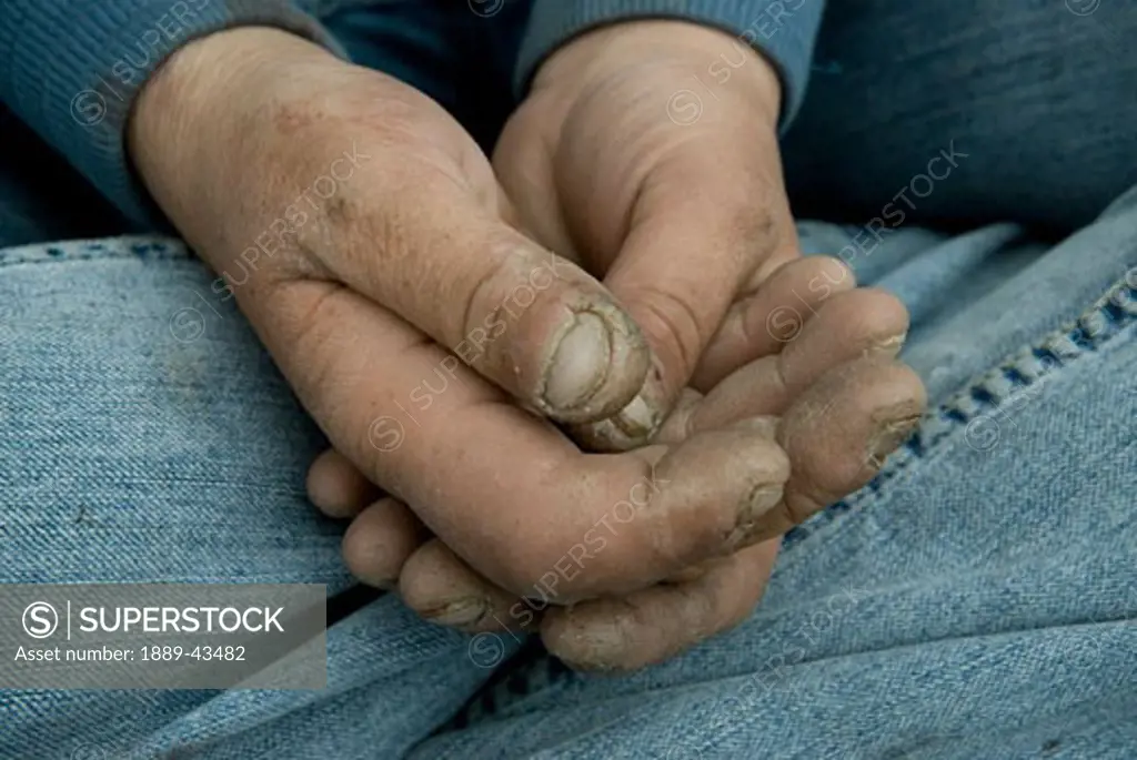 Close up of swollen battered hands