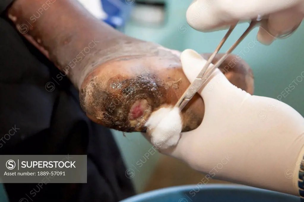 Nurse Cleaning A Man´s Foot That Has Leprosy, Manica, Mozambique, Africa