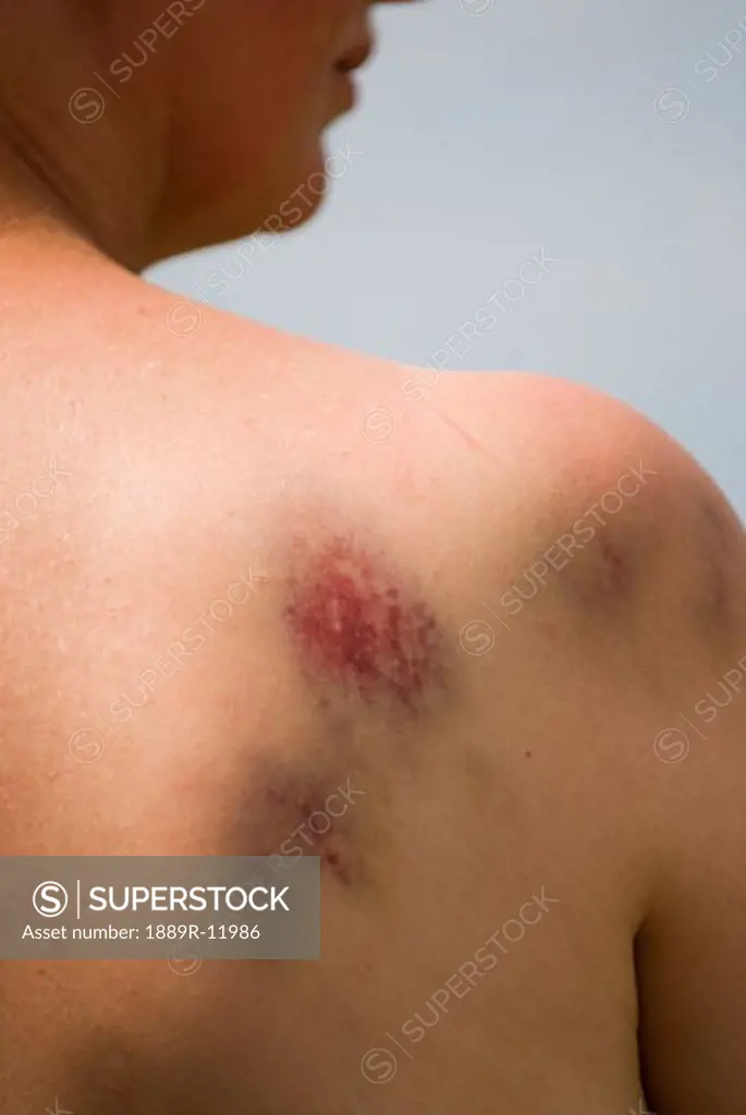 Bruising on woman's right shoulder  