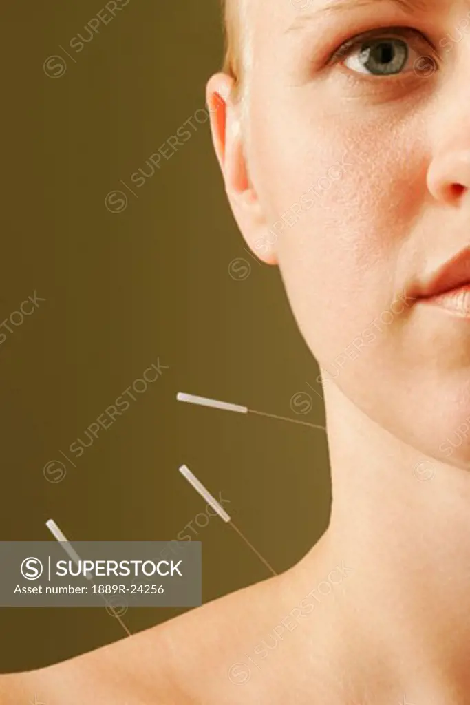 Women receiving acupuncture treatment