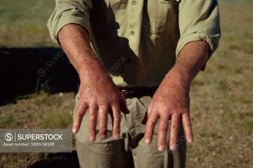 Tourist´s hands with mosquito bites, Namibia, Africa