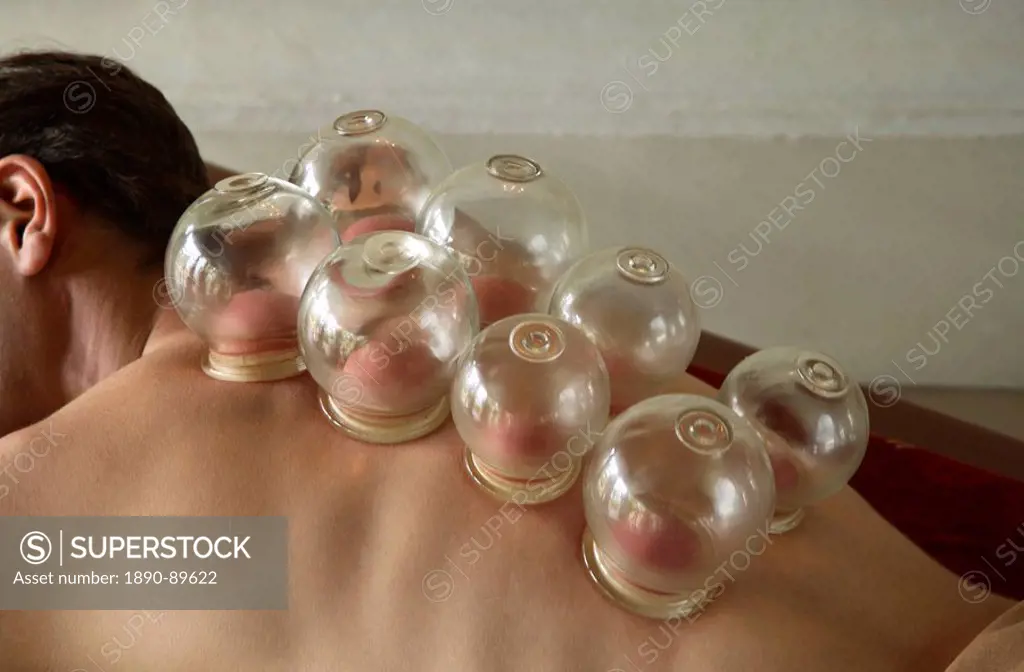 Chinese cupping, China, Asia