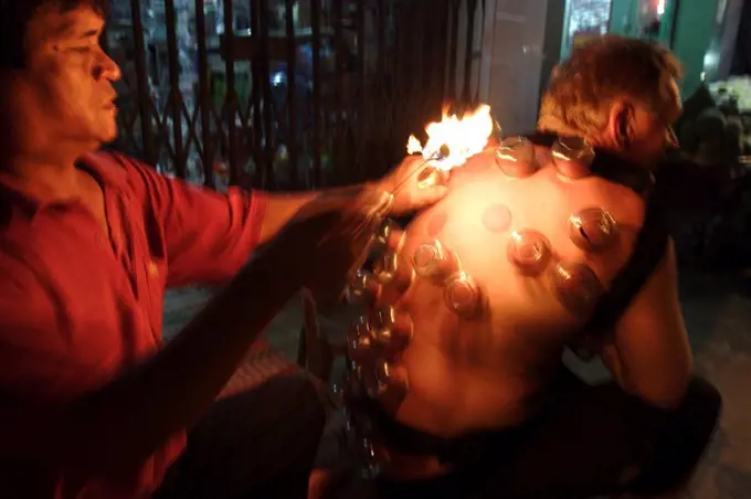 Fire cupping performed on a tourist, Can Tho, Vietnam, Indochina, Southeast Asia, Asia