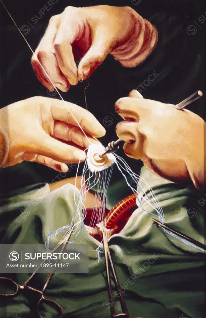 One of a series of paintings by Keith Holmes. A replacement valve is ready for positioning in the patient´s heart. Two of the three hands are those of...