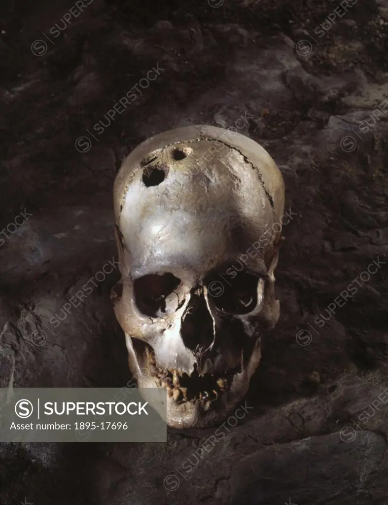 This skull, excavated from Jericho in Palestine, shows four trepanned holes. Trepanning was the ancient practice of cutting holes in the skull, probab...