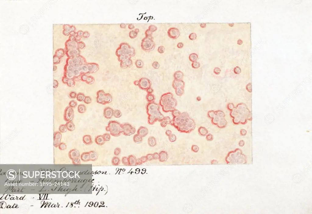 From a collection of 15 watercolour illustrations of pox lesions in human skin, consisting mostly of smallpox with the exception of one chickenpox. Th...