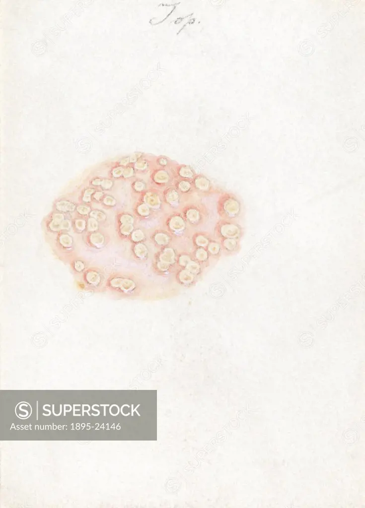 One of a collection of 15 watercolour illustrations of pox lesions in human skin, consisting mostly of smallpox with the exception of one chickenpox. ...