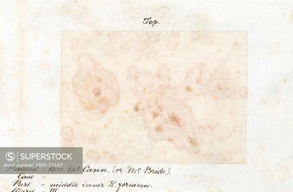 From a collection of 15 watercolour illustrations of pox lesions in human skin, consisting mostly of smallpox with the exception of one chickenpox. Th...
