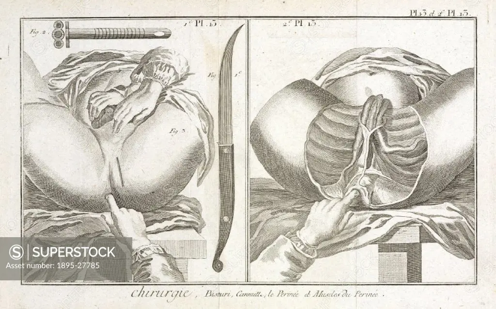 Plate 13 showing two surgical instruments and anatomical diagrams of the perineum and the muscles of the perineum. From the 1780 quarto edition of ´La...