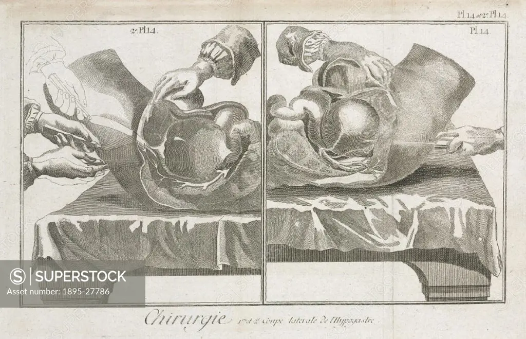 Plate 14 showing two anatomical diagrams illustrating first and second lateral incisions of the lower abdomen. From the 1780 quarto edition of ´La Gra...