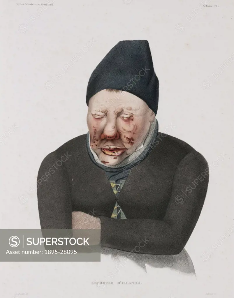 Lithograph by Talbaux after Bevalet, of a woman leper from Iceland. Illustration from the medical atlas section in Voyage en Islande et au Groenland ...