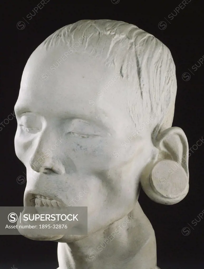 Plaster cast of the head of a member of the Brazilian Botocudos tribe, probably for phrenological use, made by O´Neil.