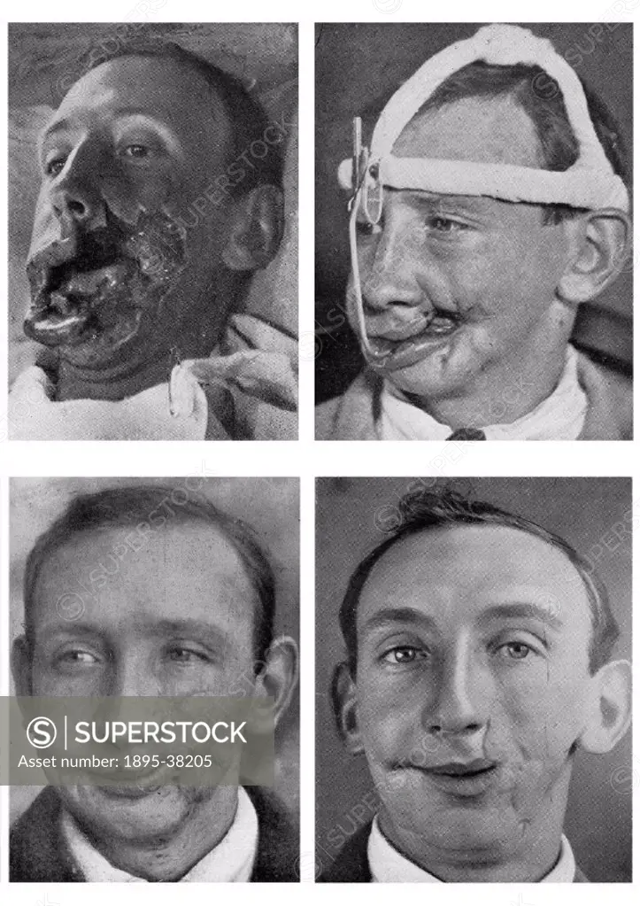 Four photographs documenting the facial reconstruction of a solider whos cheek was extensively wounded during the Battle of the Somme (July 1916). Ta...
