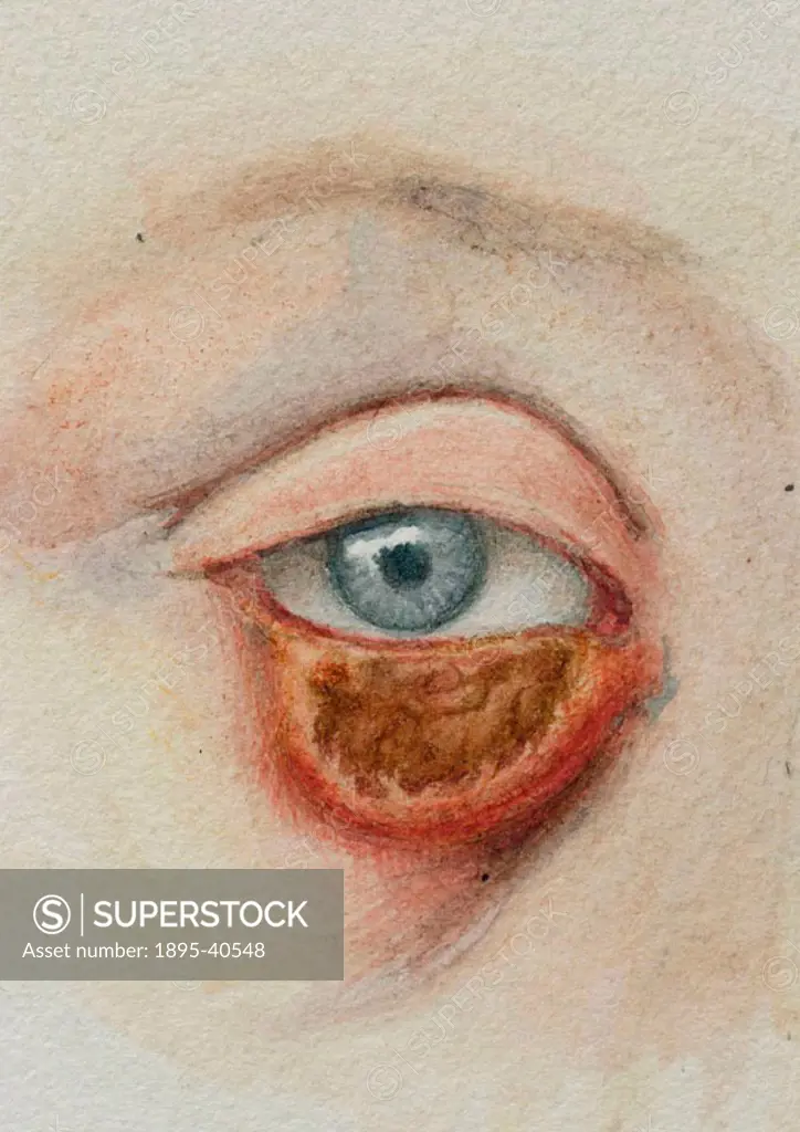Watercolour illustration on card by Peter Nairn of syphilitic condition of lower eyelid.