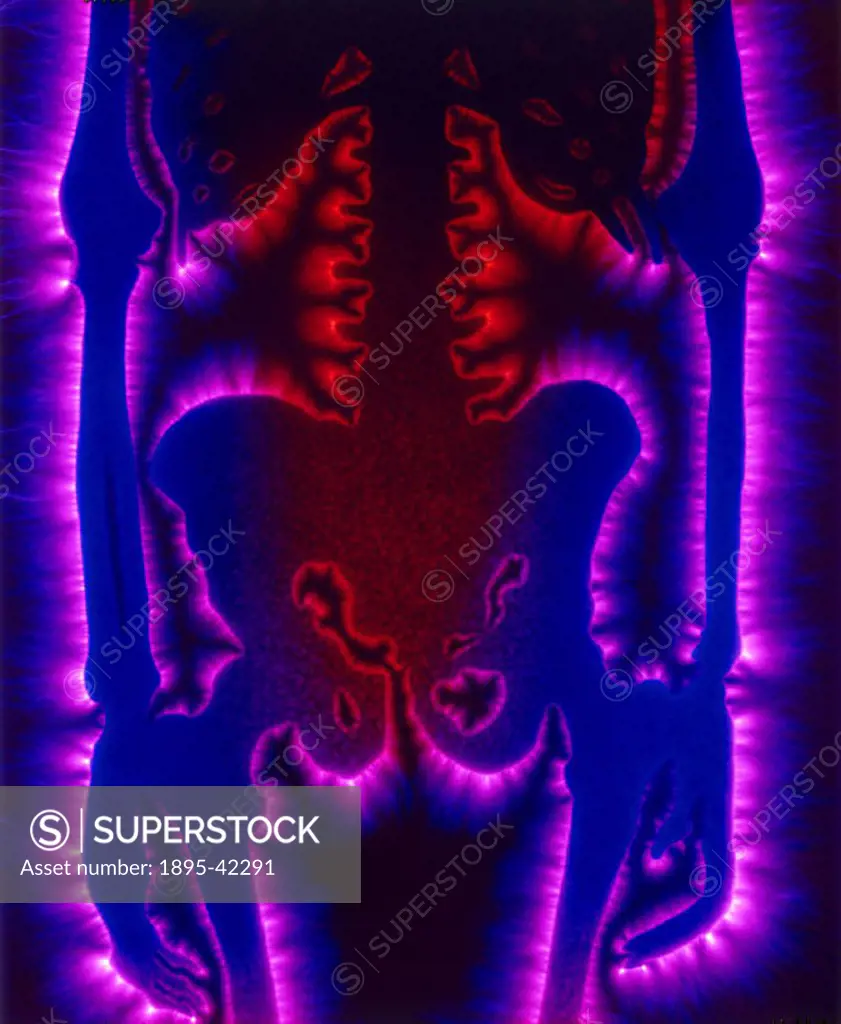 Kirlian photograph of a human skeleton.The process of Kirlian photography is named after Seymon Kirlian, an amateur inventor and electrician of Krasno...