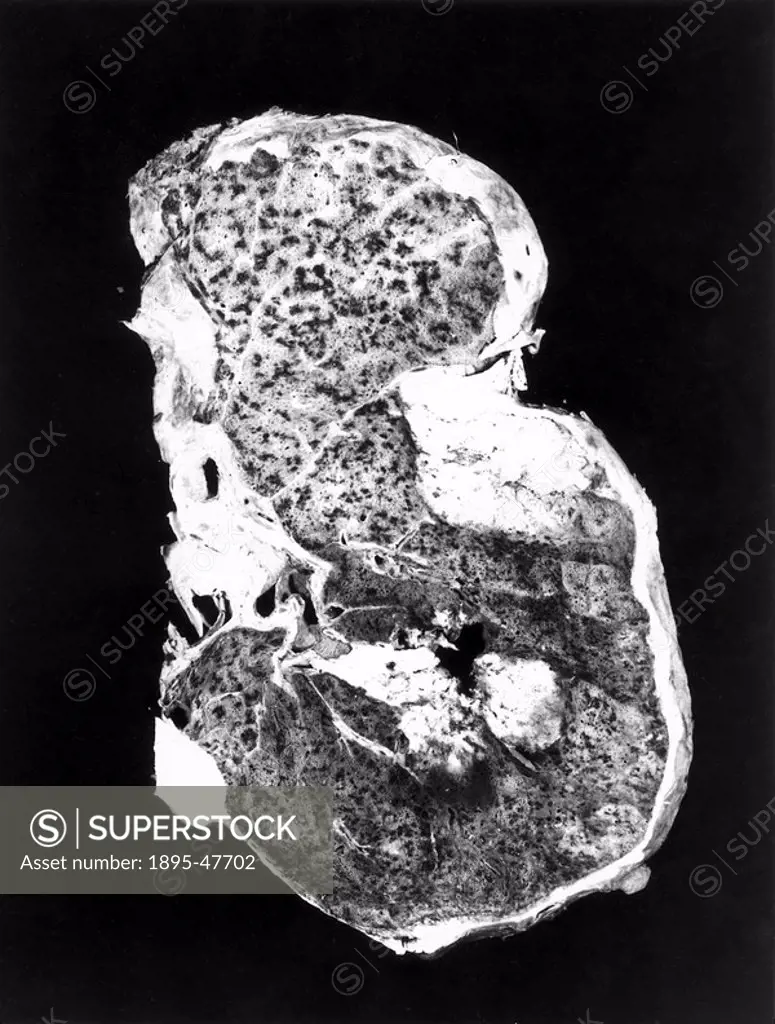Whole lung section, c 1970 Photograph of a whole lung section from D M, case number 81 in Dr P C Elmes´ work with McCaughey and Wade to produce the fi...