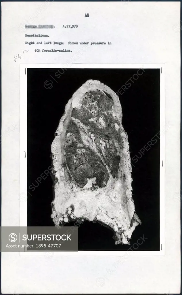 Post-mortem photograph of diseased lung, c 1965 Photograph of a whole lung section from G C, case number 48 in Dr P C Elmes´ work with McCaughey and W...