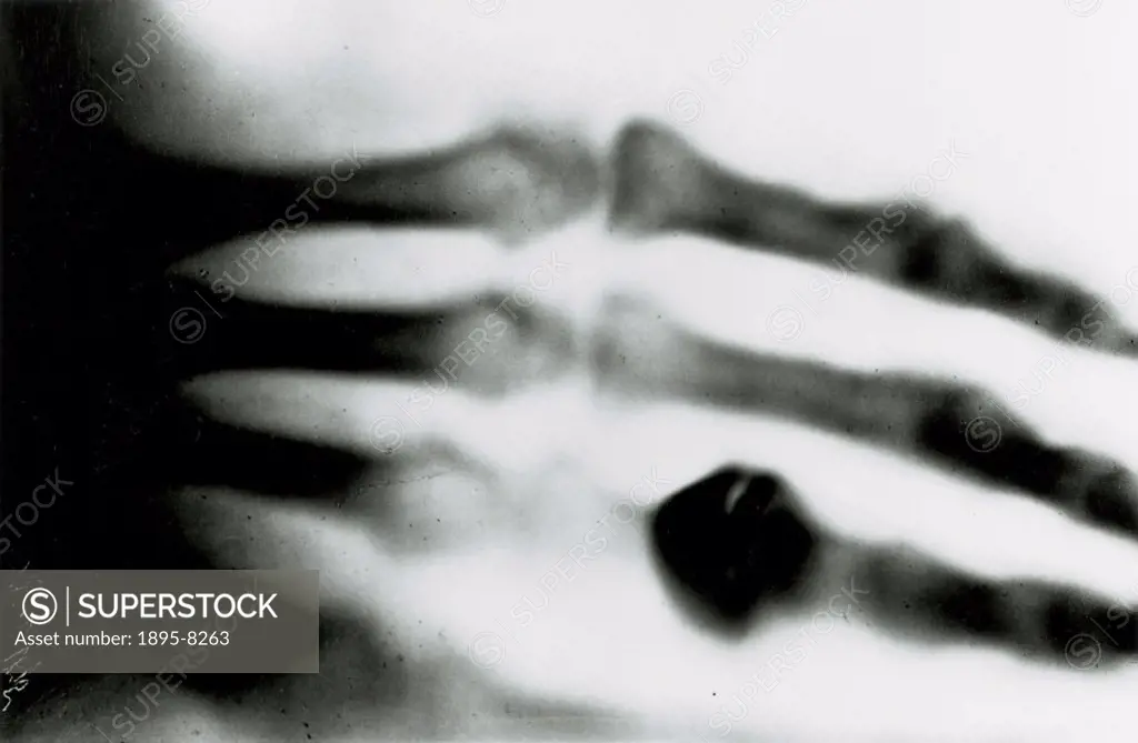X-ray photograph taken by Wilhem Conrad Roentgen (1845- 1923), of his wife´s hand in December 1895 (some sources give the date as 22 December 1895). R...