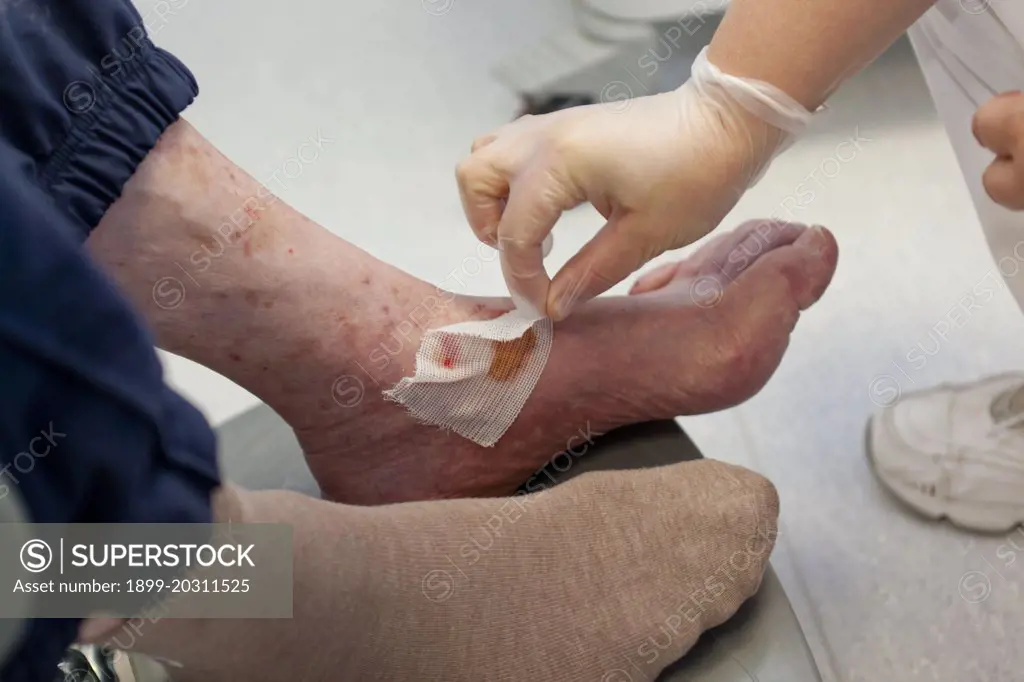  Photo essay in a retirement home in the department of Loiret (La Boisserie, Montargis), France. Care undertaken on a diabetic person. The lesion has occured following a friction.