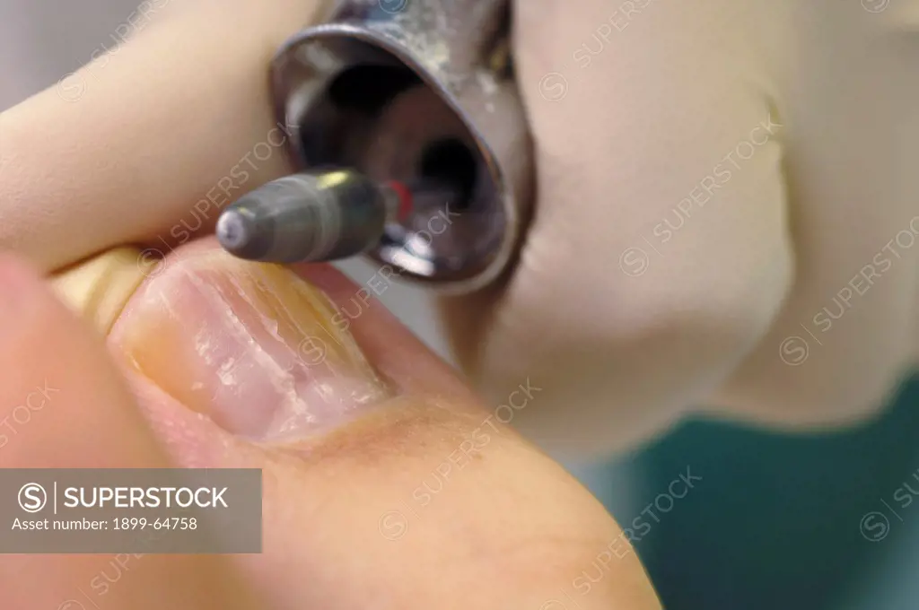 Podiatrist uses rotary tool to remove dead skin from