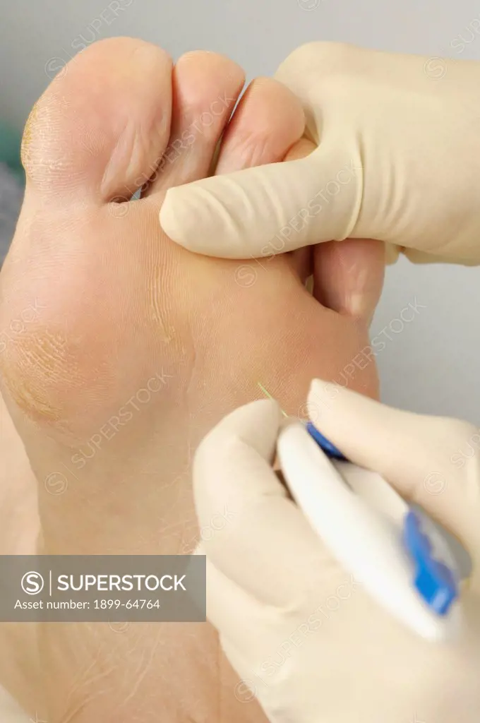Podiatrist performs foot sensitivity test on patient