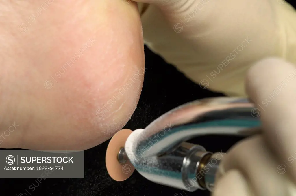 Podiatrist uses rotary tool to remove calluses from