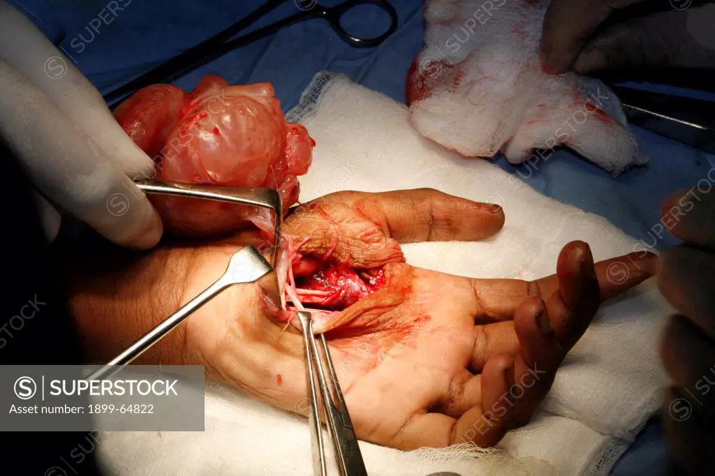 Surgeons removing neurofibroma from patient's hand