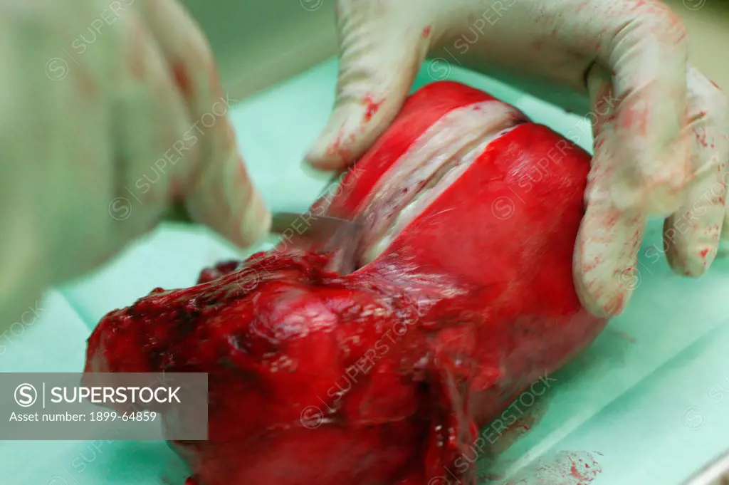 Dissecting a womans uterus after its removal during