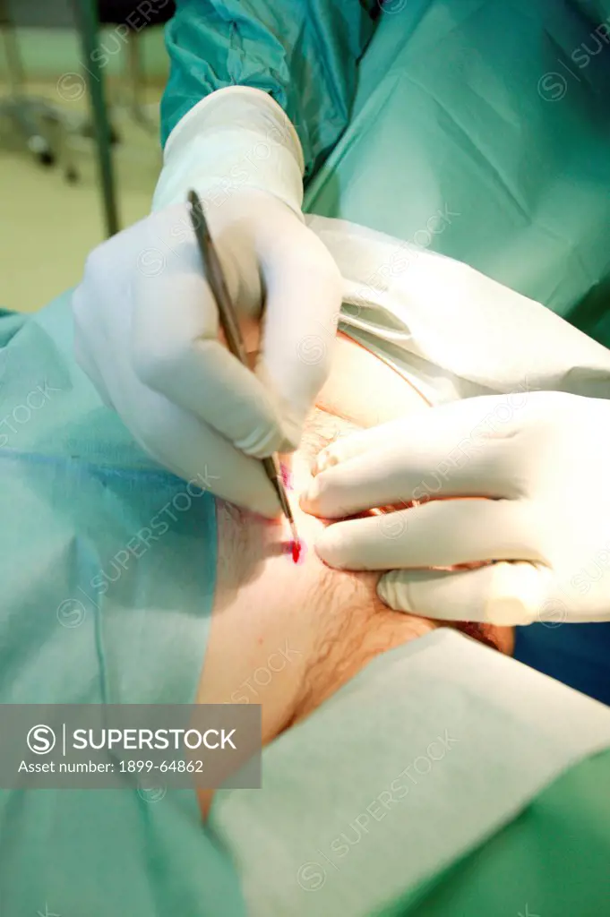 Surgeon using a scalpel to make an incision into the
