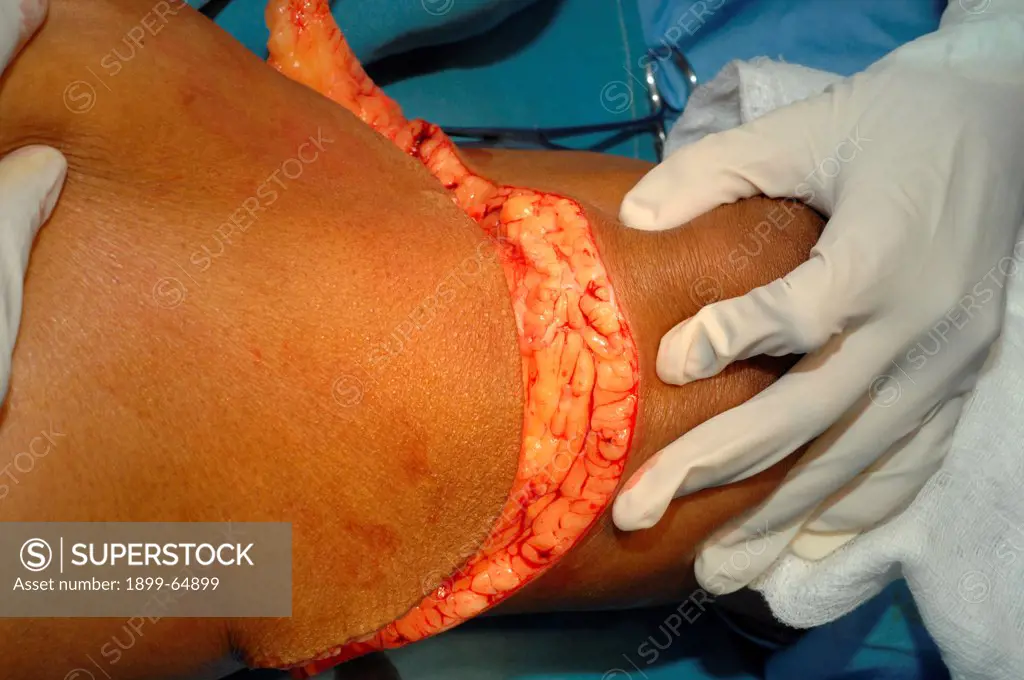 Incision is deepened as far deep fascia all around leg,