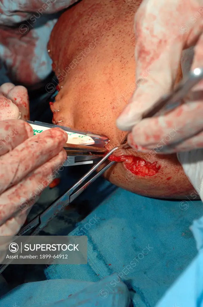 Surgical staples are used to close the wound,