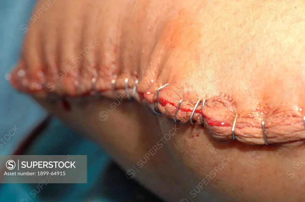 Closed wound, following the amputation of a right leg.