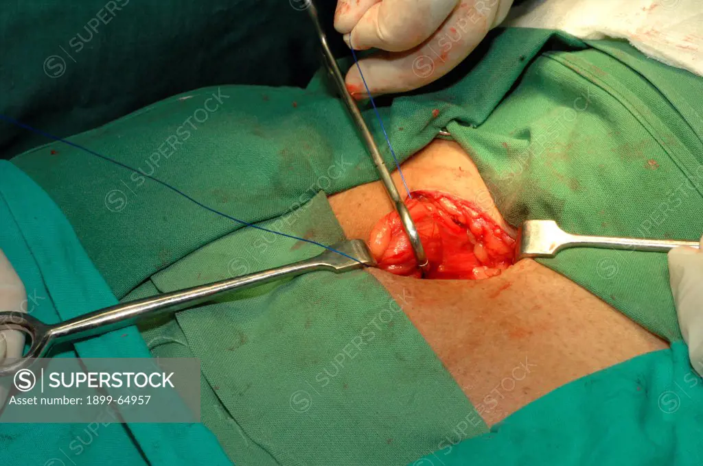 Surgeon repairing direct inguinal hernia on patient