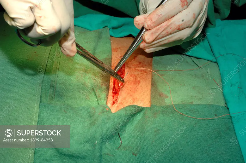 Surgeon closing the wound after repairing a direct