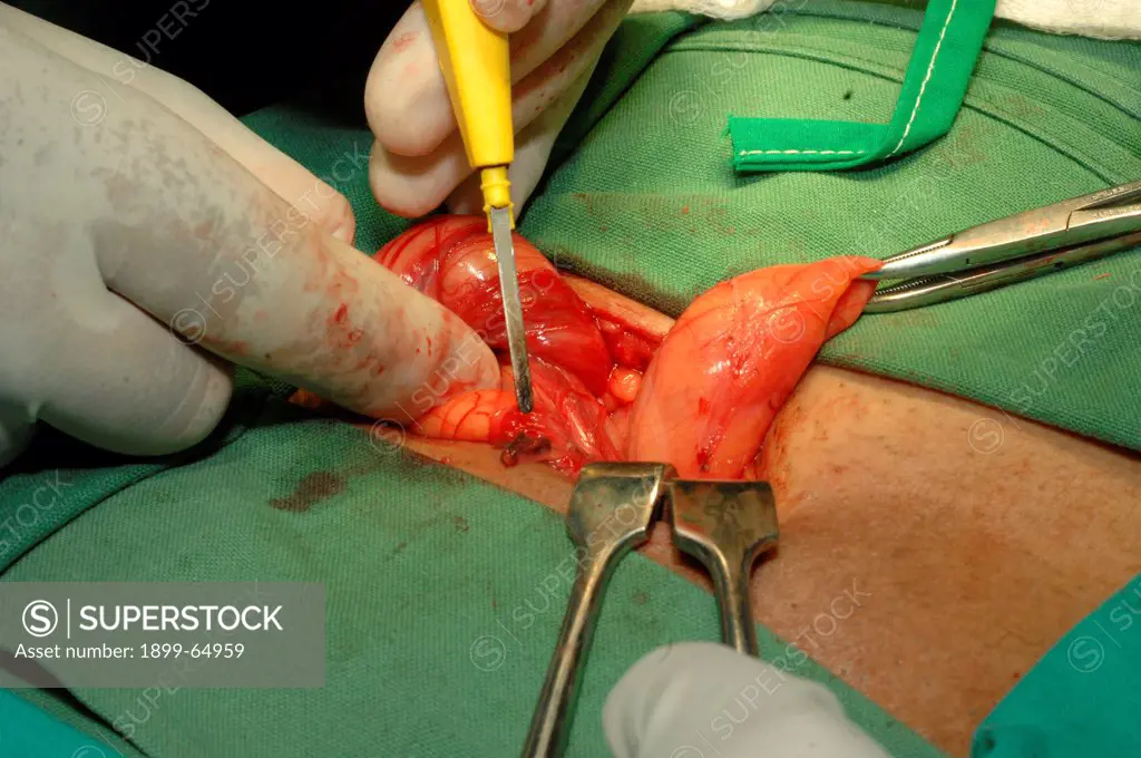 Surgeon repairing direct inguinal hernia on patient