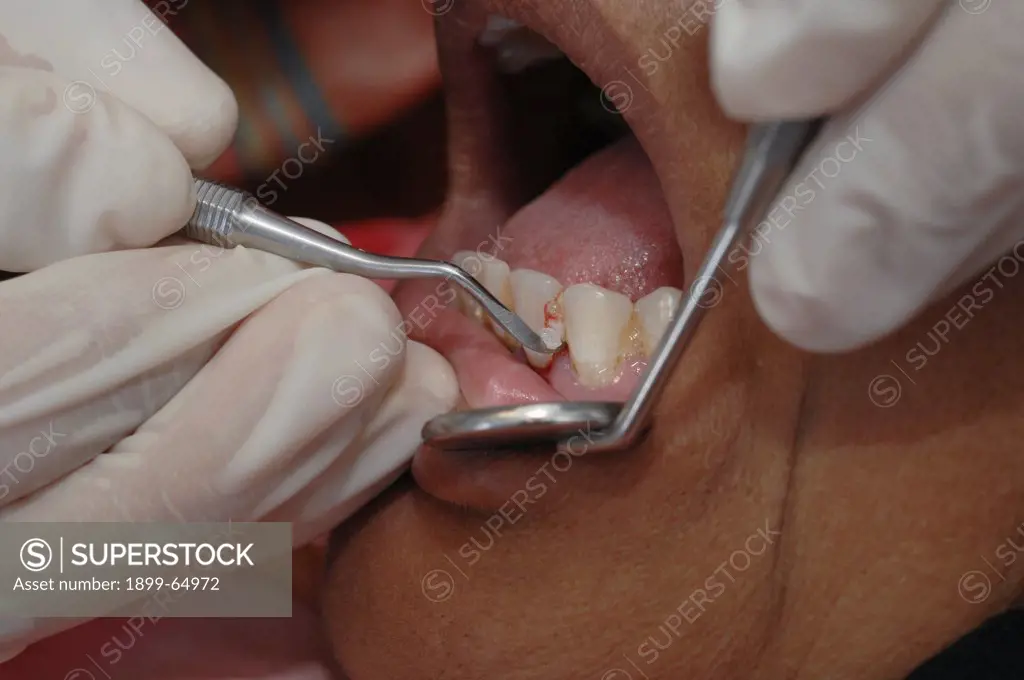 Dentist scraping off plaque and tartar build from