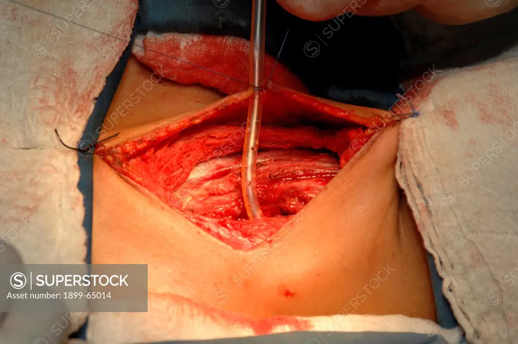 The surgeon repairing incision through pretracheal fascia