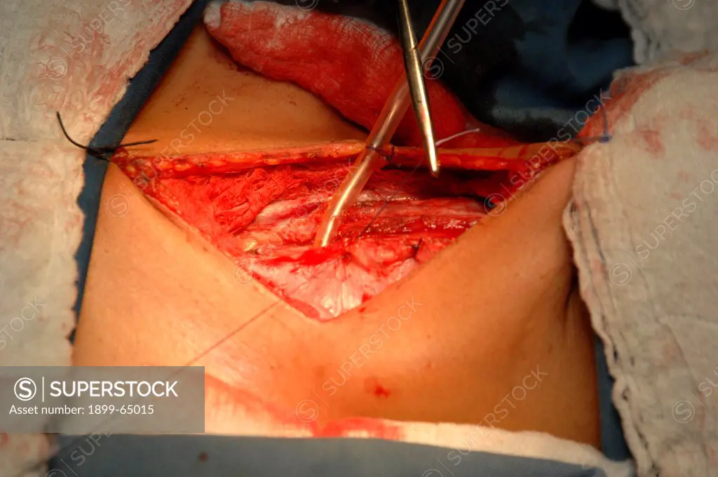 The surgeon repairing incision through pretracheal fascia
