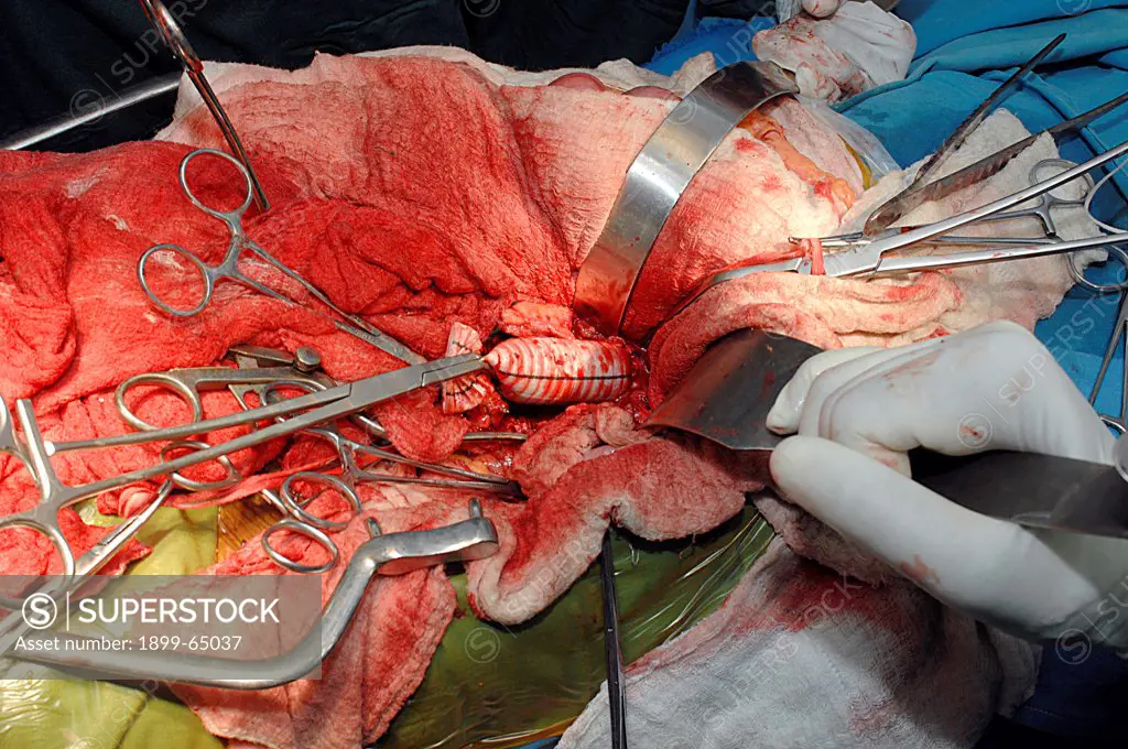 Surgeons completing proximal anastomosis with graft
