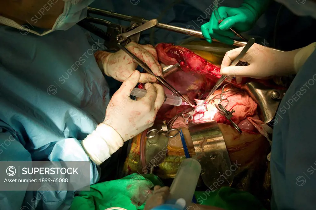 Surgeons performing liver transplant.