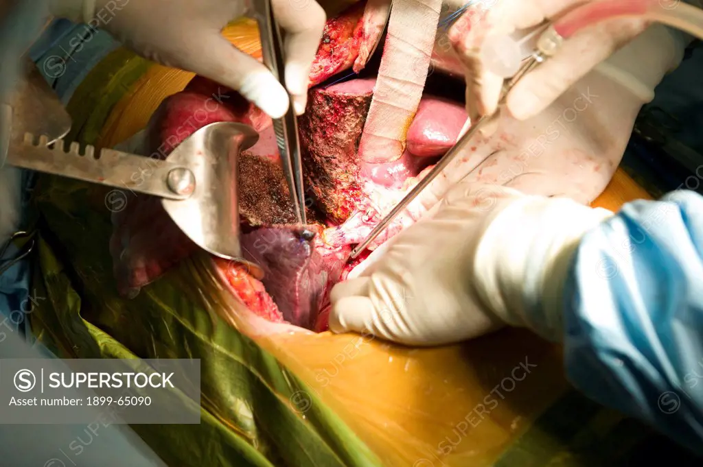 Surgeons performing liver transplant.